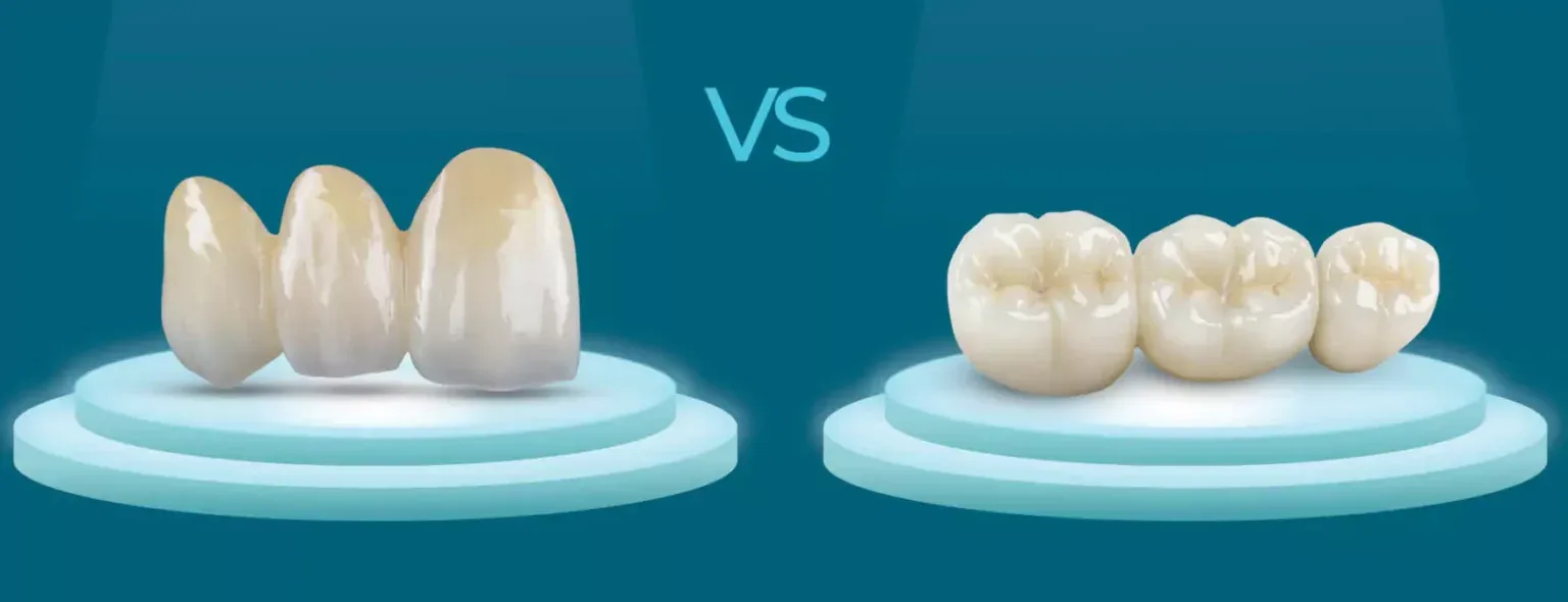 Металокераміка